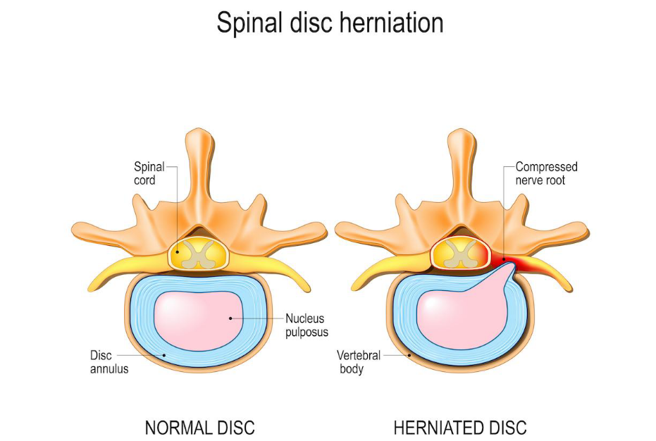 Sciatica vs. Herniated Disc: What Are the Differences? Denver, Postureworks